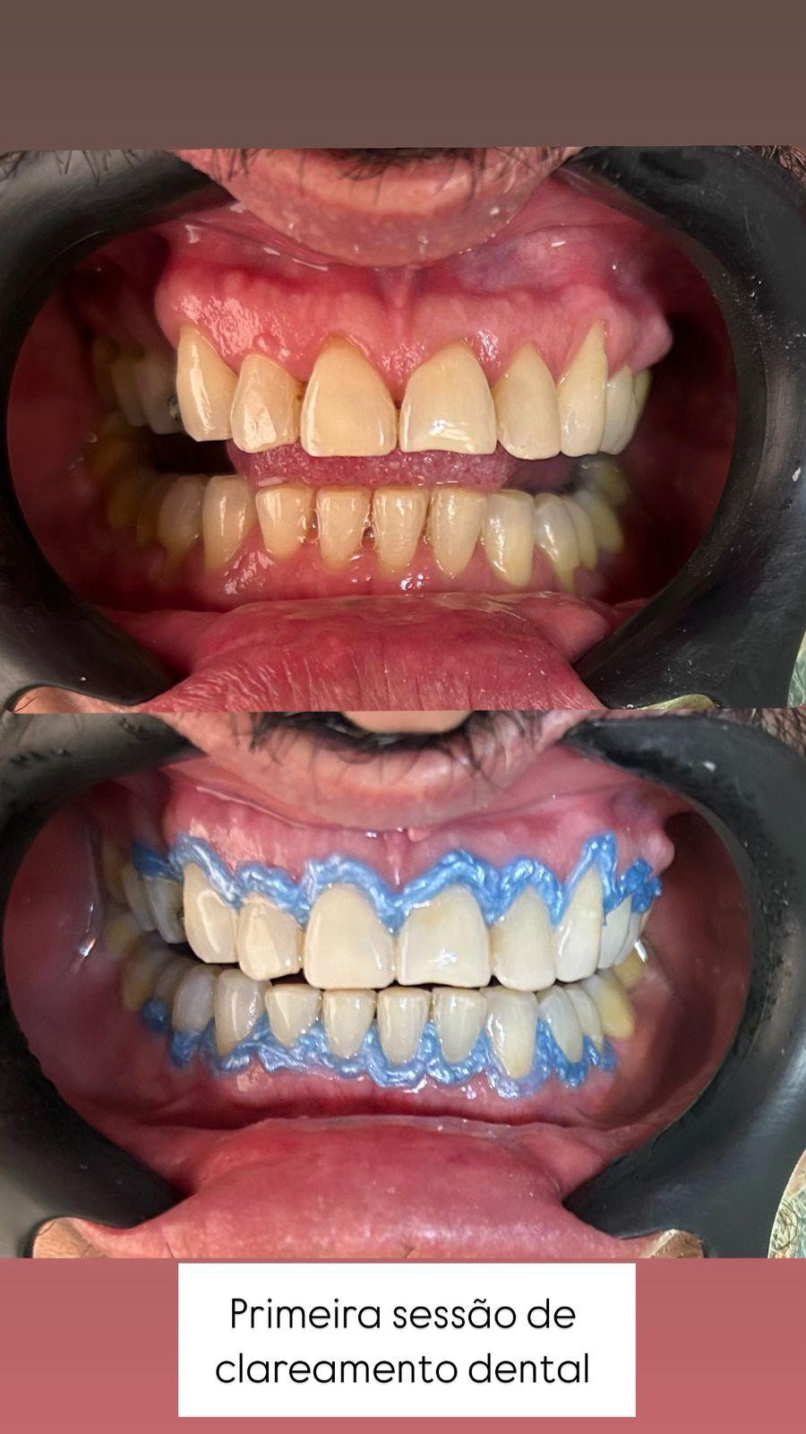 Primeira sessão de clareamento dental com proteção gengival